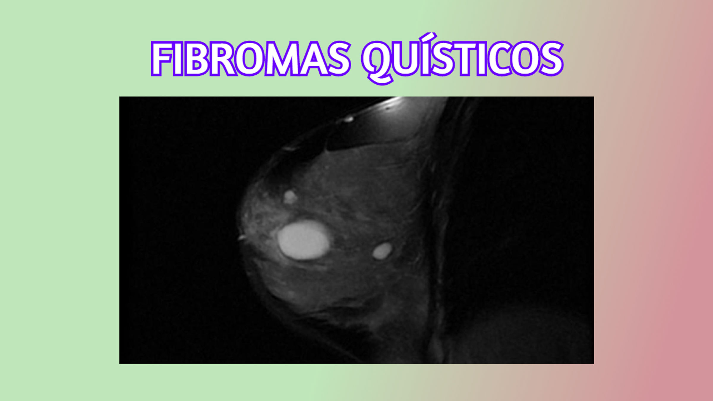 FIBROMAS QUÍSTICOS MAMARIOS